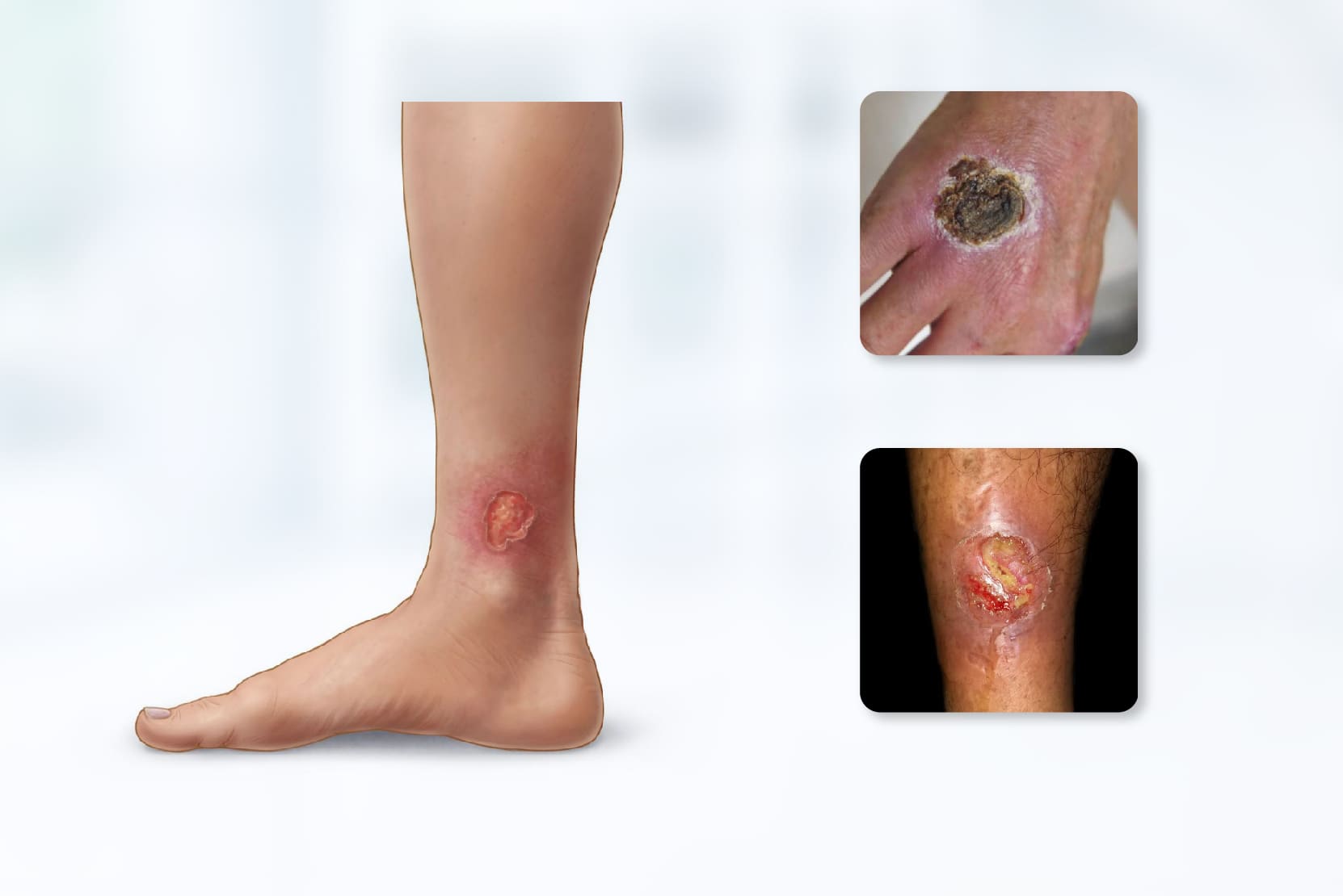 Ulcers/Wounds